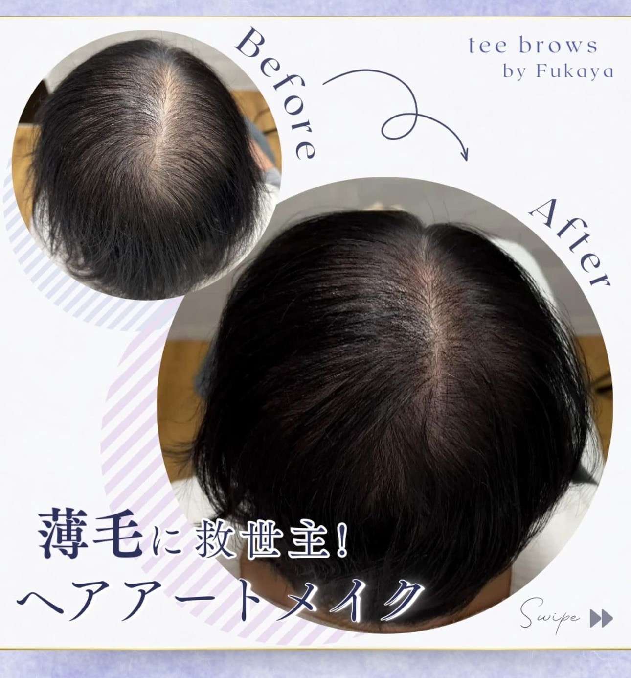 頭皮アートメイク